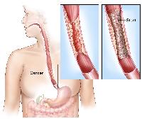 Esophageal stent. Shows cancer blocking esophagus. Insets show enlarged area of cancer and a stent placed in the esophagus to keep it open.